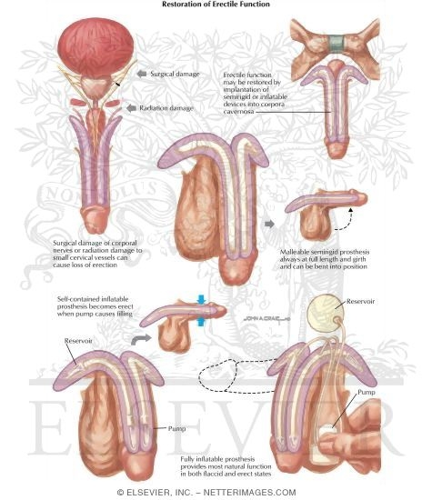 Diseases of Prostate: Restoration of Erectile Function