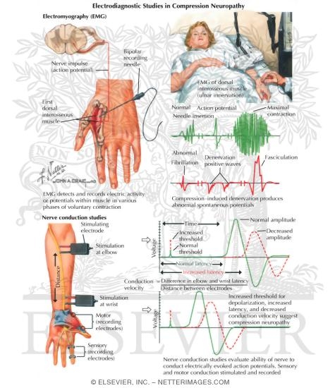 Electrodiagnostic Studies In Compression Neuropathy