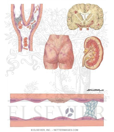 Thrombotic Disorders: Thrombocytopenic Purpura