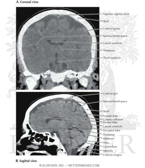 Brain Imaging: Computed Tomography Scans, Coronal and Sagittal