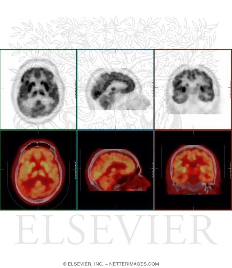 Positron Emission Tomography Scanning