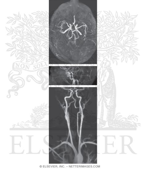 Magnetic Resonance Angiography: Frontal and Lateral Views