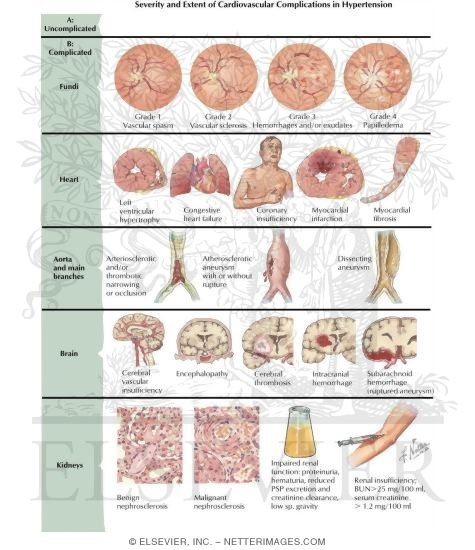HYPERTENSION COMPLICATIONS hypertension complications: