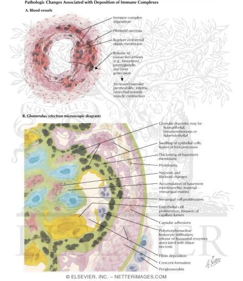Pathology of Complex Deposition