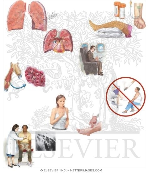 Managing Your Pulmonary Embolism (compression stocking)