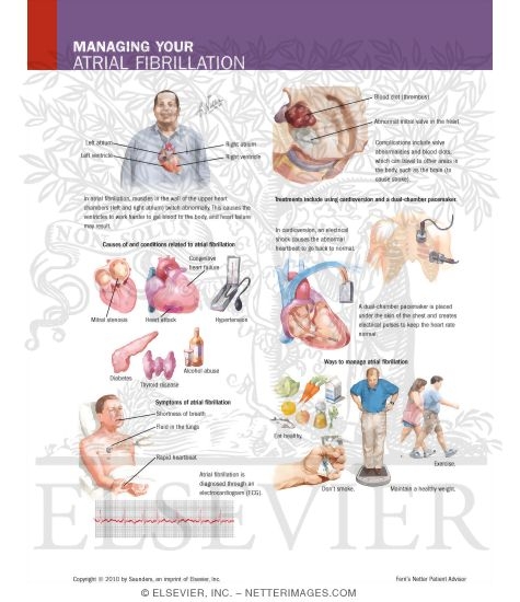 Managing Your Atrial Fibrillation