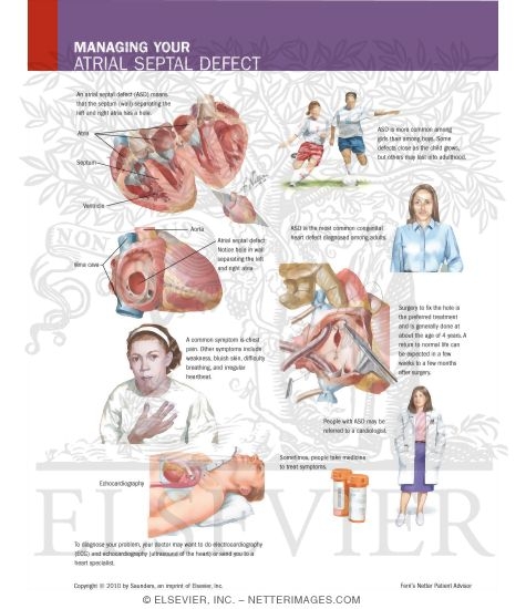 Managing Your Atrial Septal Defect