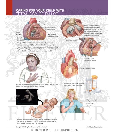 Caring for Your Child With Tetralogy of Fallot