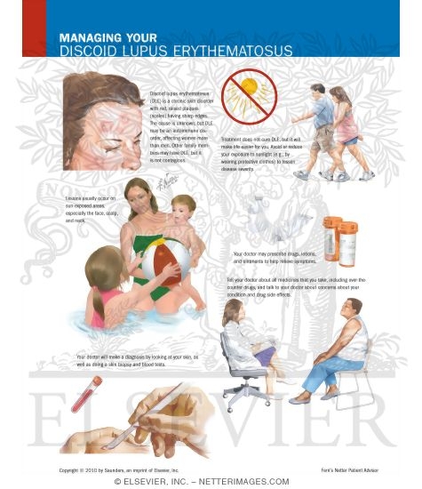 Managing Your Discoid Lupus Erythematosus
