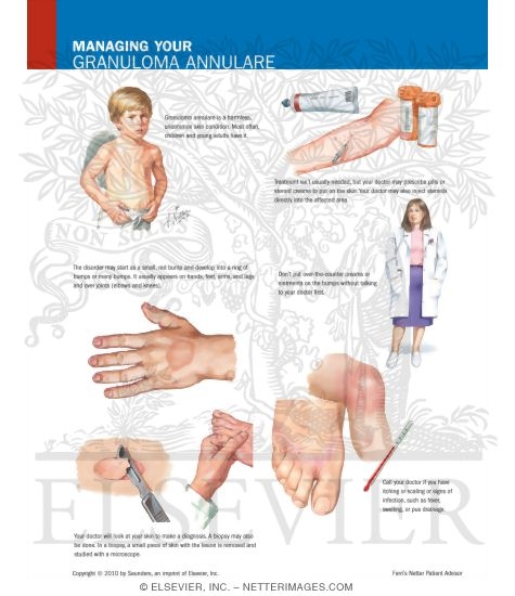 Managing Your Granuloma Annulare
