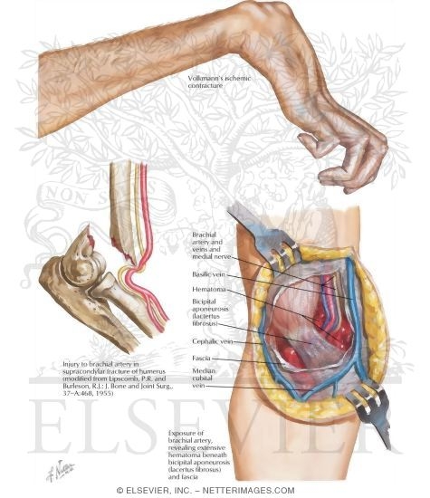 Volkmann's Ischemic Contracture