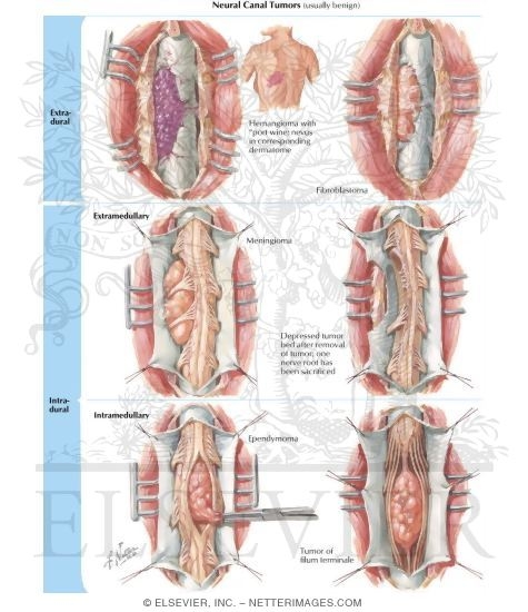 Spinal Tumors: Neural