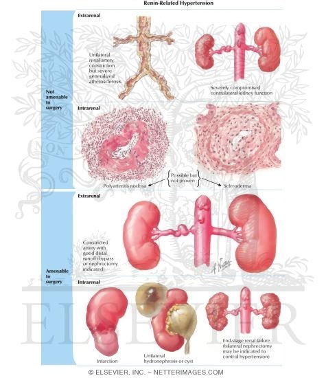 Renin-Related Hypertension