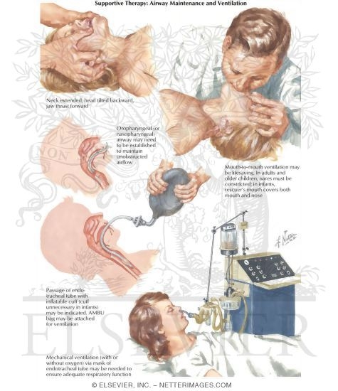 Supportive Therapy: Maintenance of Airways and Ventilation