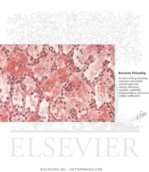 Kerosene Poisoning: Lung