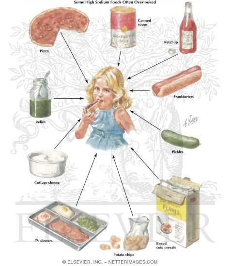 Some High Sodium Foods Often Overlooked In High Blood Pressure