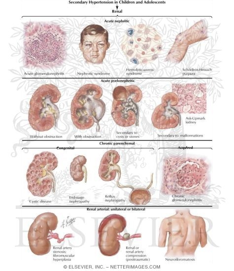 HYPERTENSION COMPLICATIONS hypertension complications: