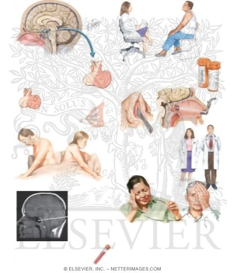 Managing Prolactinoma