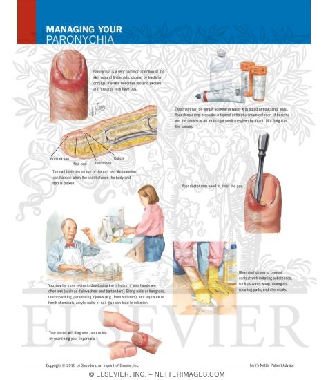 Managing Your Paronychia