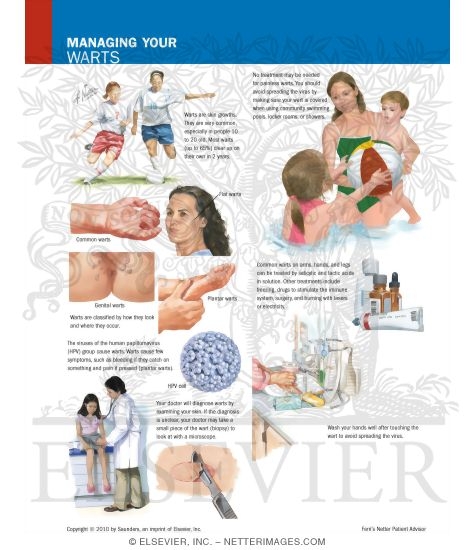 Managing Your Warts
