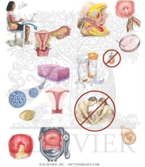 Managing Your Cervicitis