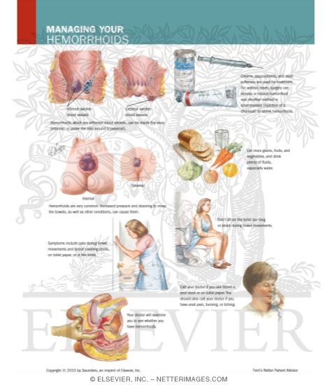 Managing Your Hemorrhoids
