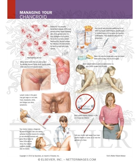 Managing Your Chancroid