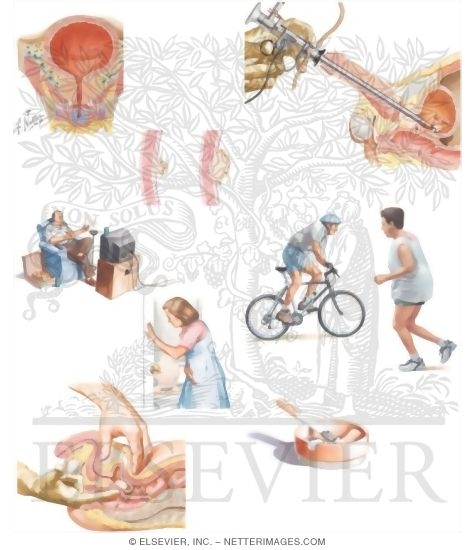 Managing Your Bladder Cancer
