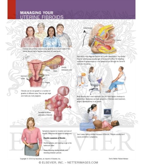 Managing Your Uterine Fibroids - Netter Medical Illustrations