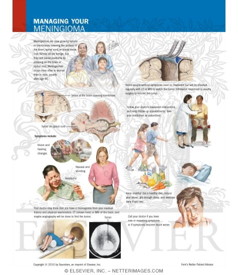 Managing Your Meningioma