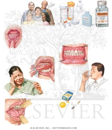 Managing Your Stomatitis