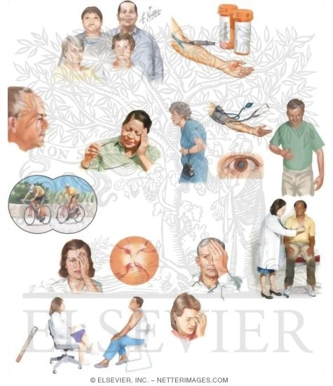 Managing Your Giant Cell Arteritis