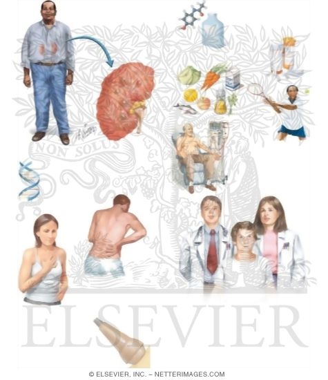 Managing Your Polycystic Kidney Disease