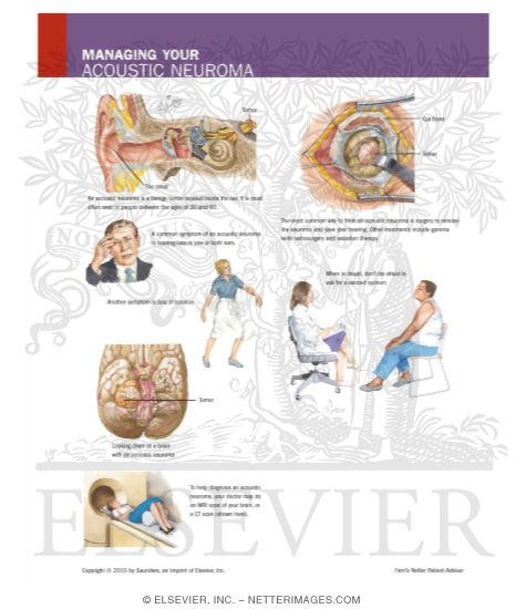 Managing Your Acoustic Neuroma
