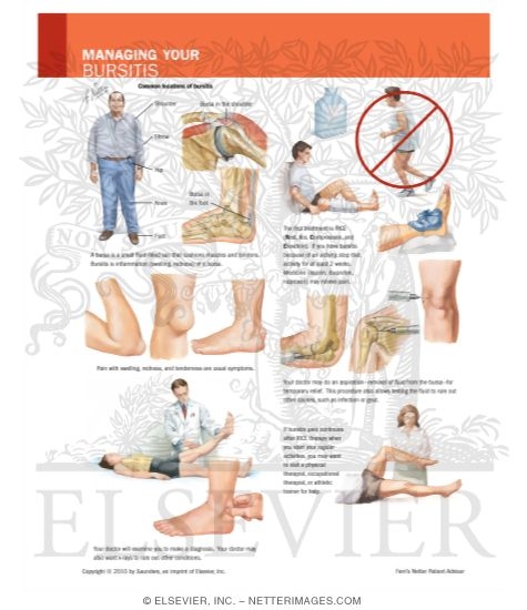 Managing Your Bursitis