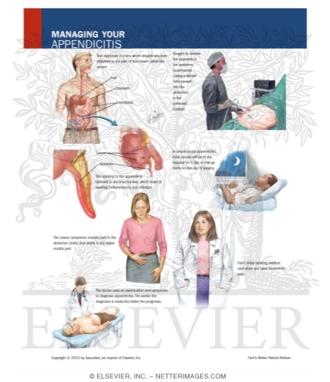 Managing Your Appendicitis