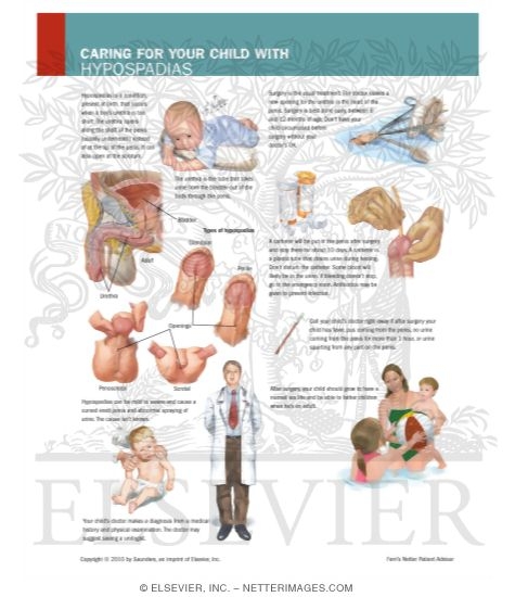 Caring for Your Child With Hypospadias