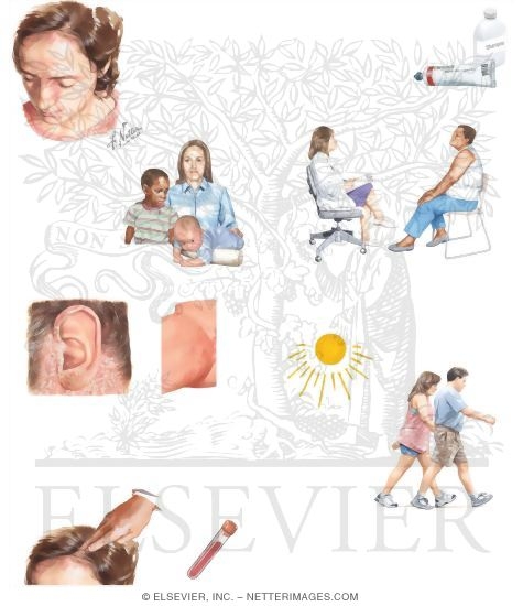 Managing Your Seborrheic Dermatitis