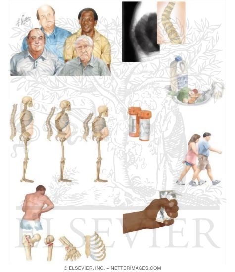 Managing Your Osteoporosis: for Men