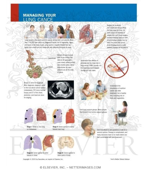 Managing Your Lung Cancer