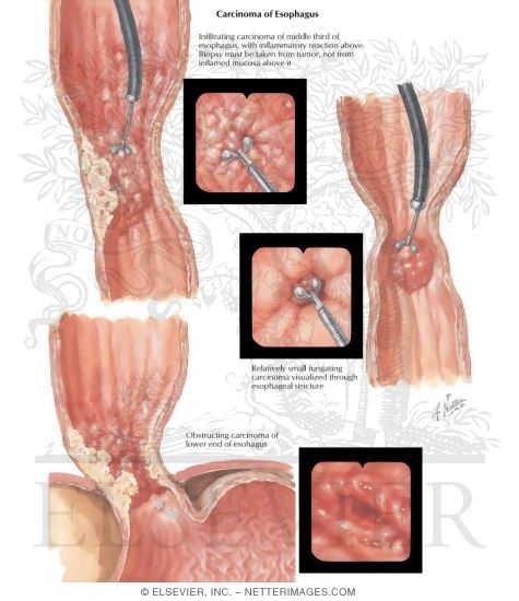 Carcinoma of Esophagus