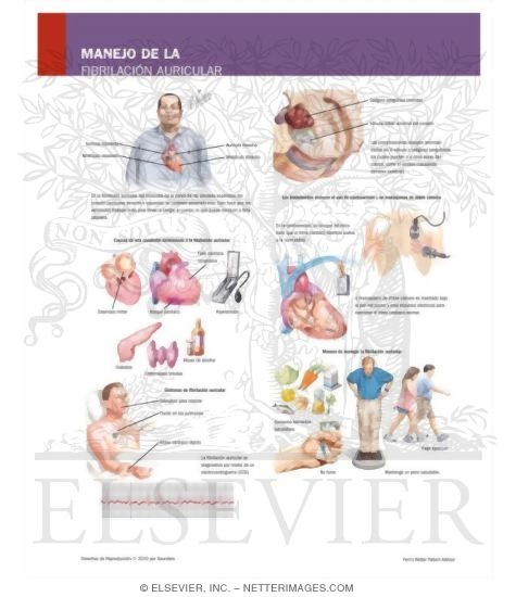 Manejo de la Fibrilaci�n Auricular