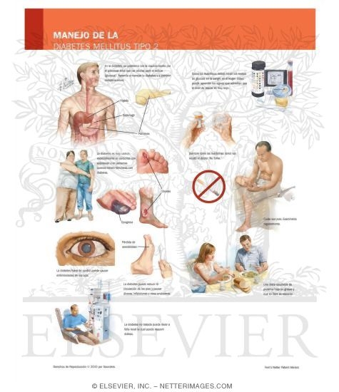 Manejo de la Diabetes Mellitus Tipo 2