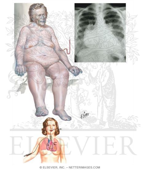 congestive heart failure. Congestive Heart Failure and