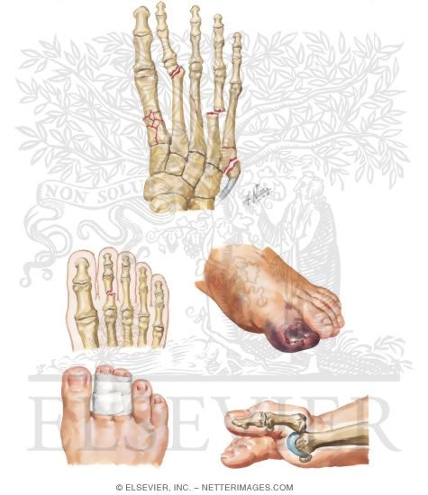 Injury to Metatarsals and Phalanges
