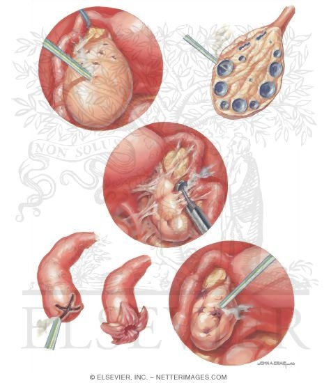 Laser Techniques In Infertility