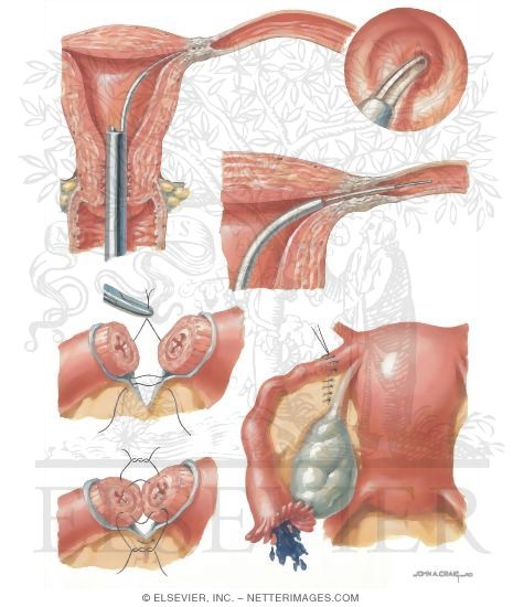 Tubal Factor