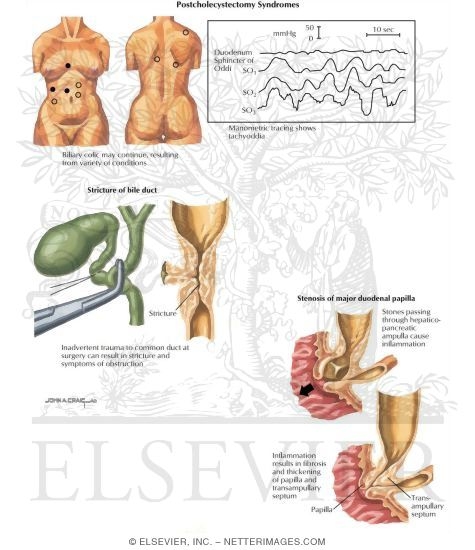 Gallstones: Post Cholecystectomy Syndromes