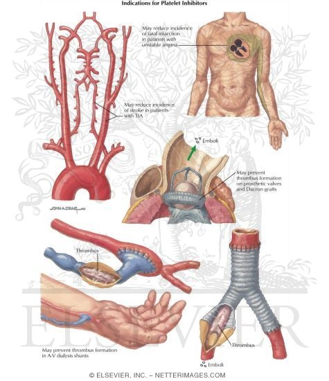 Thrombotic Disorders: Indications for Platelet Inhibitors