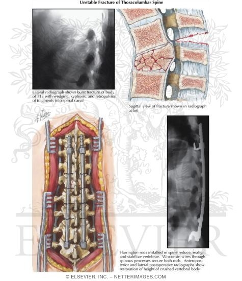 Unstable Fracture of Thoracolumbar Spine